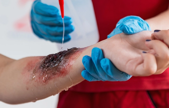 Burn Injuries
