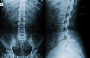 Xray film showing spinal column.