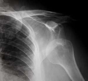 Broken shoulder from a workplace injury. 