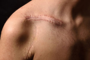 Houston Scarring and Disfigurement Injury Lawyers